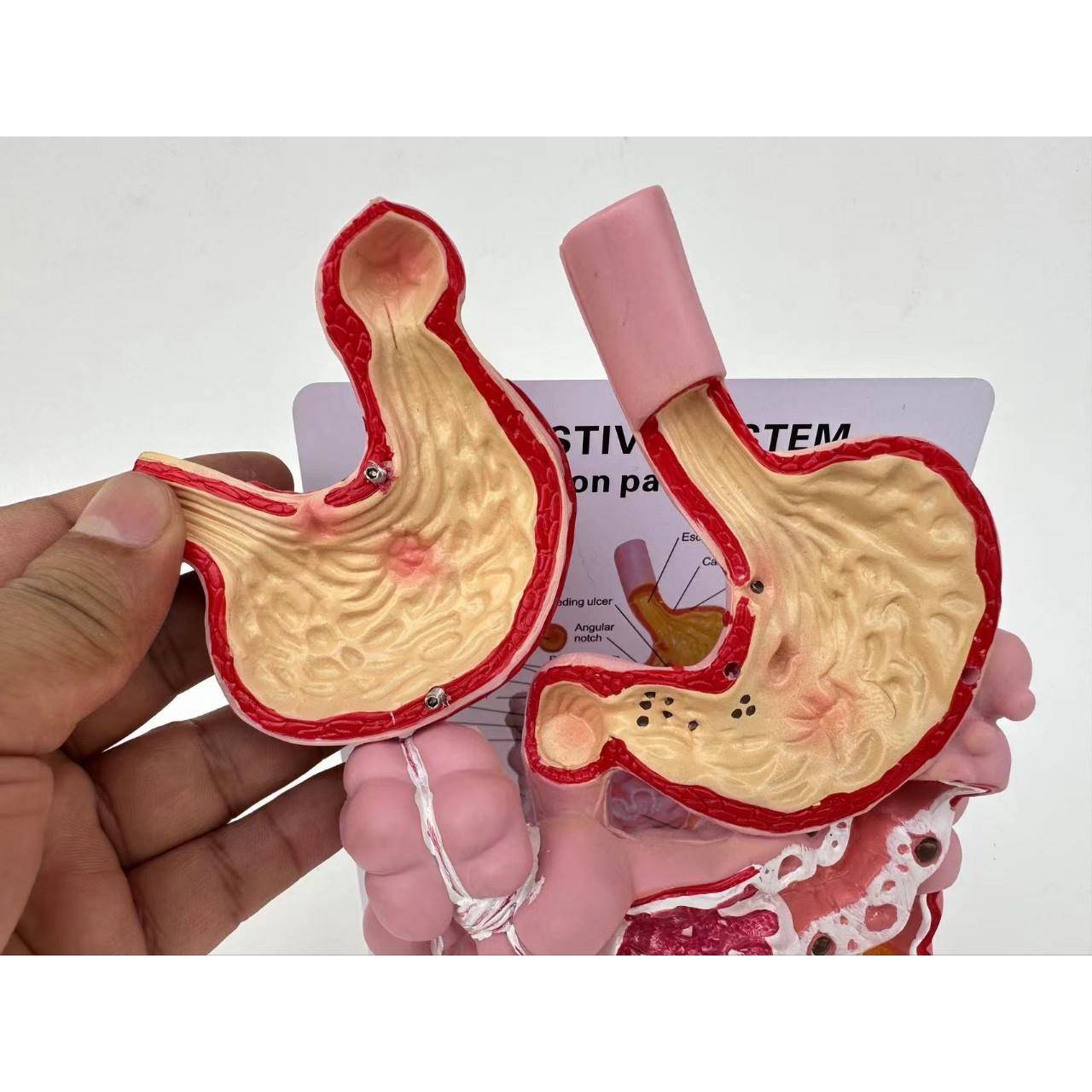 人体消化系统胃病理穿孔胃溃疡肠理病变大肠盲肠十二指肠教学