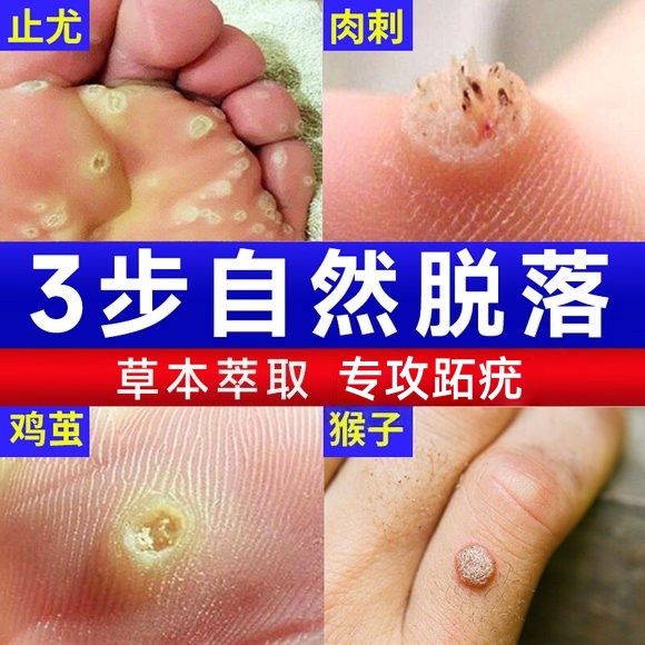 跖疣专用去足疣根特效寻常刺猴拓趾脚底膏药手脚底上长肉刺去猴子粒肉瘩疙神器专用