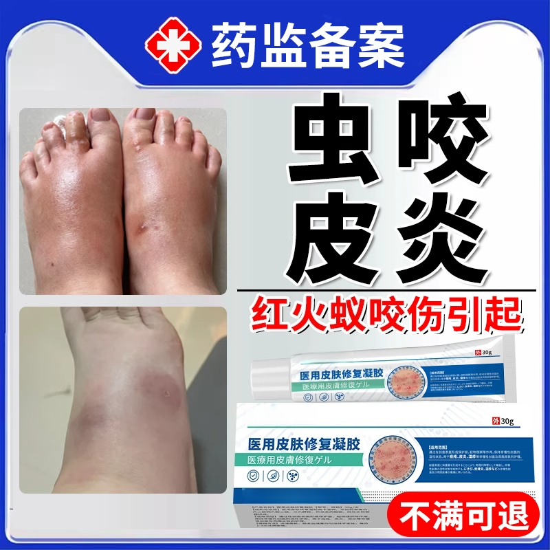 红火蚁叮咬止痒消肿克专用星被蚂蚁咬伤了擦什么药房同款膏外用