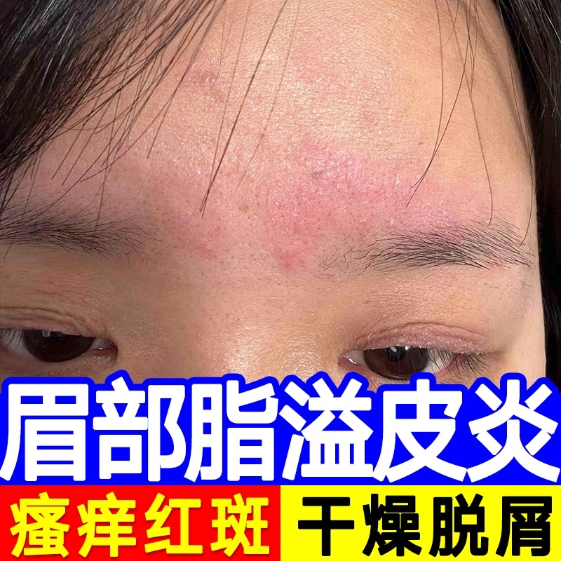 脸眉毛处眼皮痒脂溢性皮炎湿疹红肿起皮掉睫毛面部真菌感染