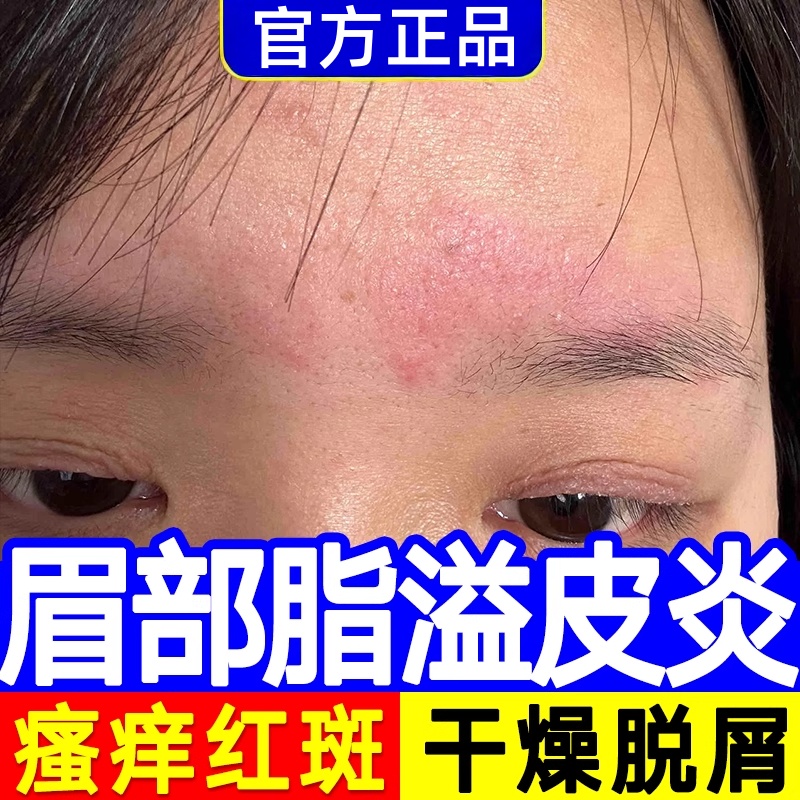 脸眉毛处眼皮痒脂溢性皮炎湿疹红肿起皮掉睫毛面部真菌感染
