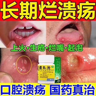 维生素B2片正品官方旗舰店口腔溃疡吃什么口舌生疮溃疡上火牙龈痛