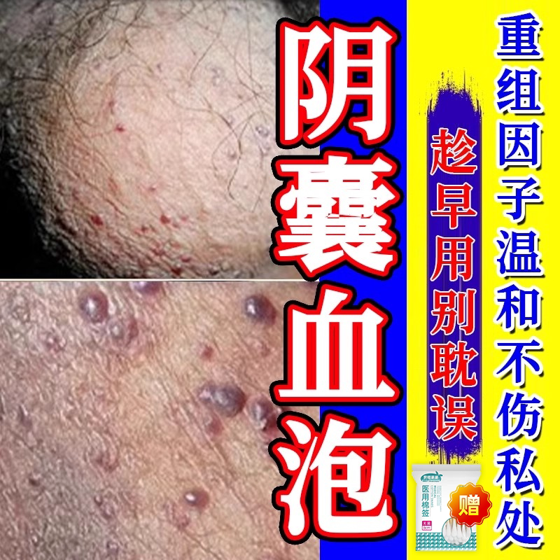 阴囊血管角化瘤阴囊湿疹瘙痒蜘蛛痣红斑血泡疼痛生殖器红色硬块sp
