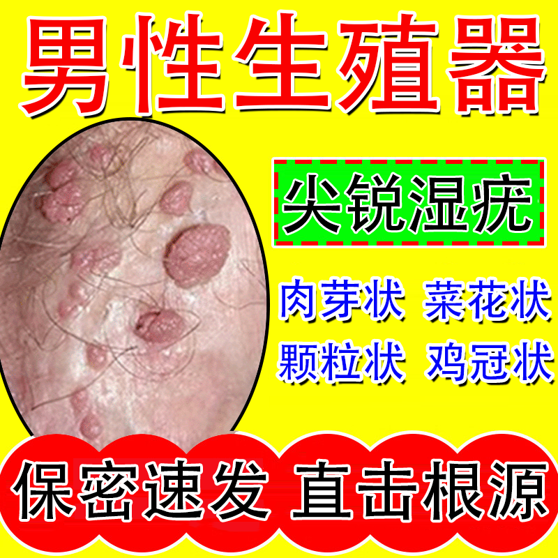 男性生殖器尖锐湿疣专用膏hpv去疣根鬼臼私处肛门克星软膏日本GX