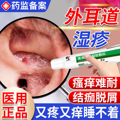 外耳道湿疹耳朵真菌感染药膏消炎耳朵外面痒止痒耳廓去顽固皮炎GX
