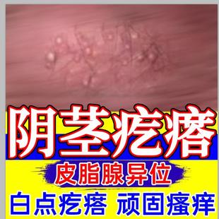 阴茎小疙瘩皮脂腺异位症男性私处白点阴囊瘙痒潮湿下面杆珠疹粒TT