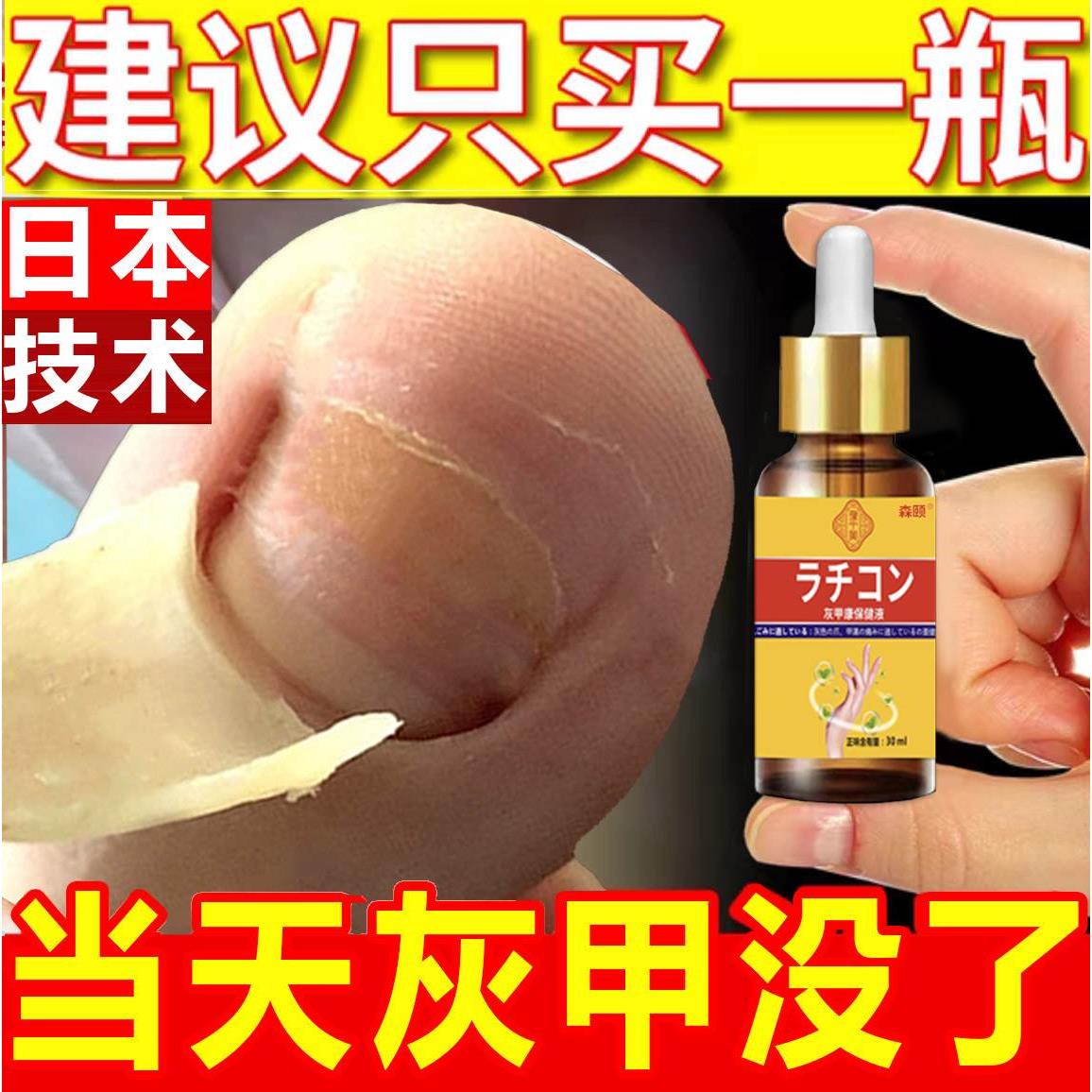 灰指甲正品亮甲灰甲水专用膏药贴阿莫罗芬旗舰店治搽剂抑菌液药水