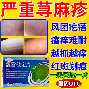 氯雷他定片治疗荨麻疹皮肤过敏瘙痒止痒药内服抗过敏药正品旗舰店