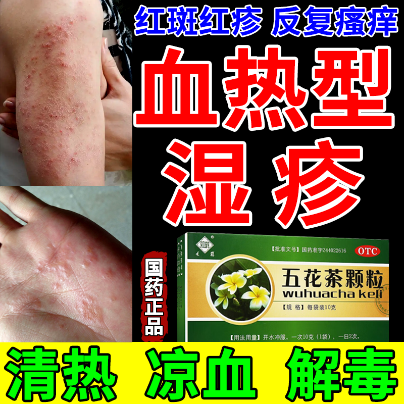 血热型湿疹凉血清热解毒五花茶颗粒去止痒药皮炎湿疹皮肤瘙痒