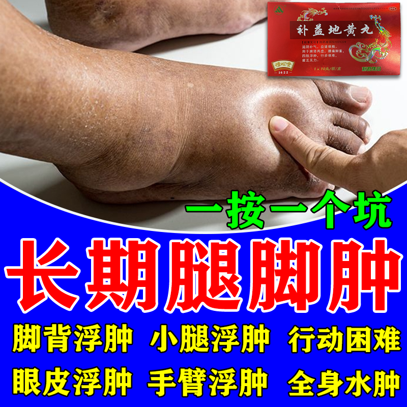 水肿消肿专用药下肢浮肿腿脚重中老年人走路困难脚背浮肿穿不上鞋