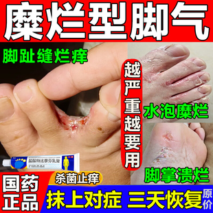 治疗脚气真菌感染喷雾药膏脚痒臭烂脚丫糜烂性脚气脚趾缝烂痒脱皮