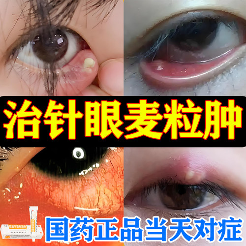 治疗针眼麦粒肿、眼部红肿、红眼病