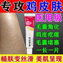 维a酸乳膏医用治疗去鸡皮肤疙瘩毛囊角化症专用药大腿手臂去角质