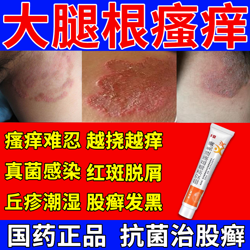 【舒夫林】曲安奈德益康唑乳膏0.1g10mg*15g*1支/盒