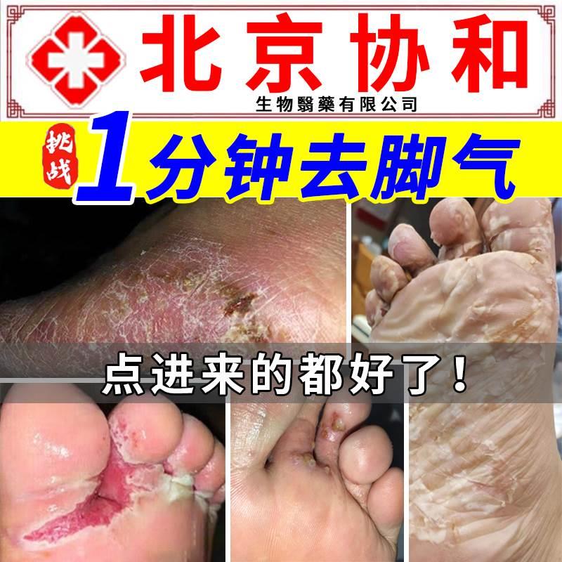 脚丫子痒烂脚喷剂脚癣一次净脱皮脚气去止痒脚癣真菌感染根药膏YX