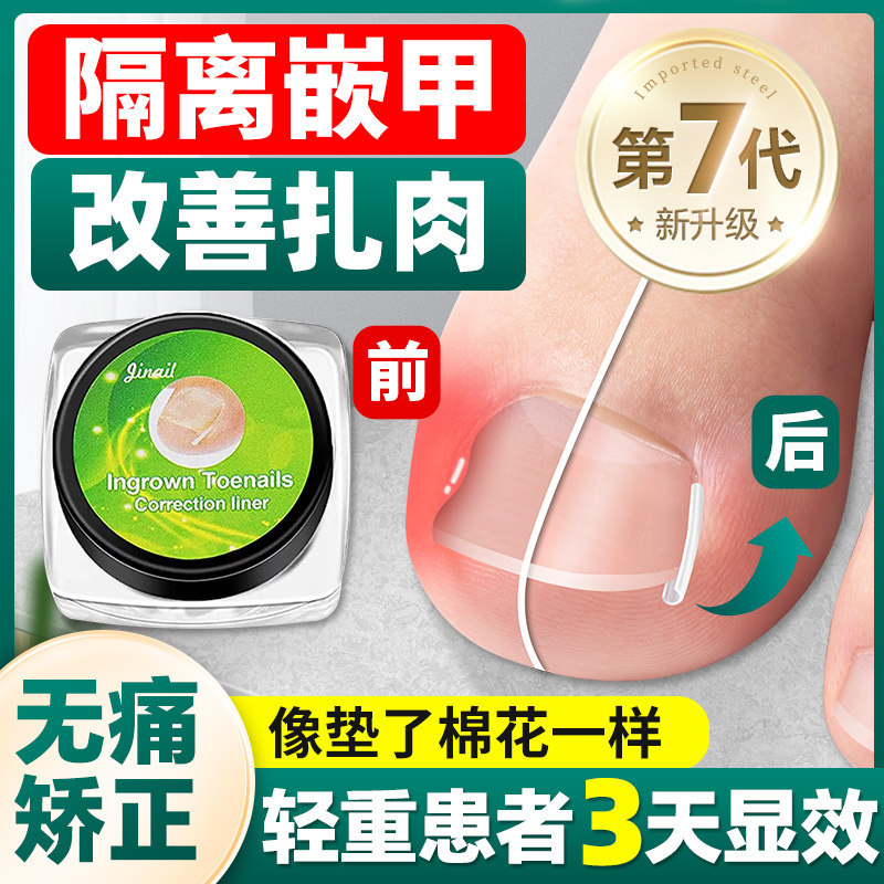 速发甲沟矫正器指甲矫正贴片用甲专嵌防脚指甲往肉里长纠正甲垫充
