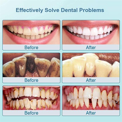 速发Ultraso Det Scer  Teeth Tt St oth Ccul