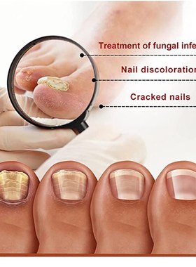 iBeaLee 7DAYS Repair Nail Fungus Treatments Essence Foot Car