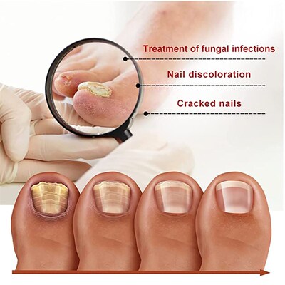 iBeaLee 7DAYS Repair Nail Fungus Treatments Essence Foot Car