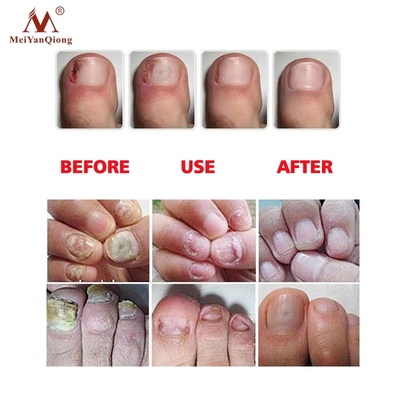 1PCS Fungus Nail Treatment Feet From the Fungus Nail Repair