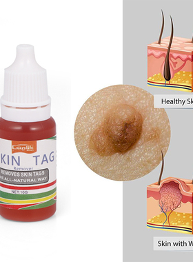 10ml Treatment Papillomas Removal of Warts Liquid kill Remov