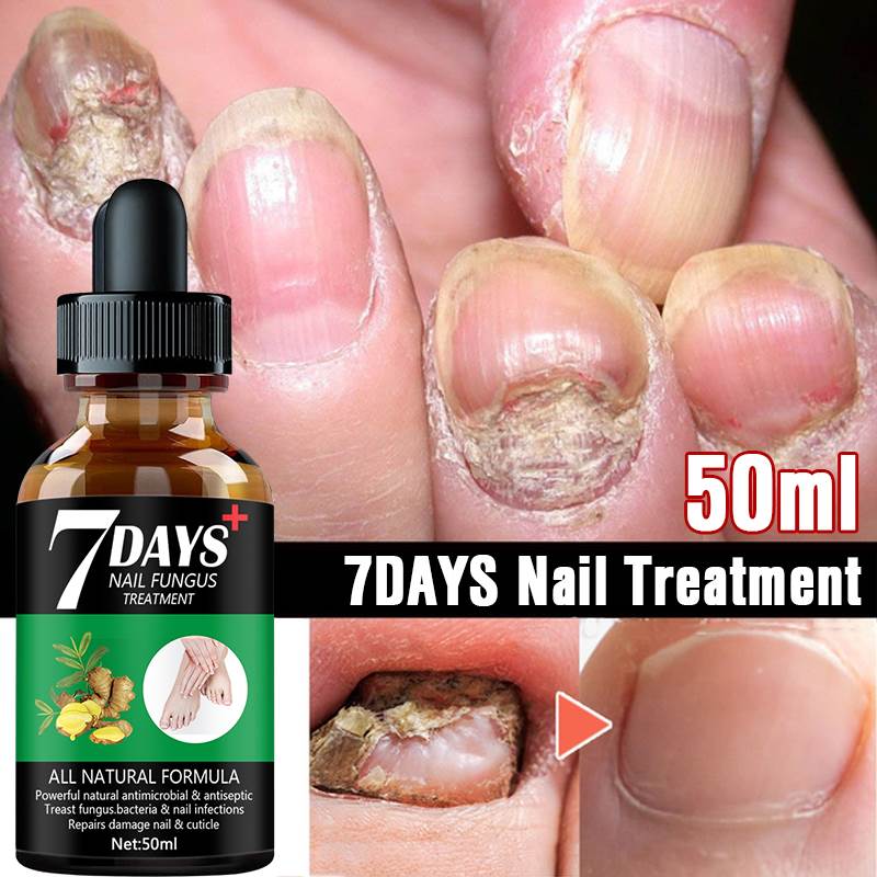 Nail Fungus Treatment Essence Serum Care Hand and Foot Care