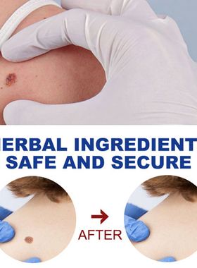 Skin Care Beauty & Health Removing Against Moles Warts Remov