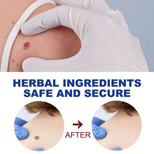 Skin Care Beauty & Health Removing Against Moles Warts Remov