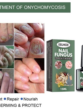 Nail Fungal Cure Nail Fungus Removal Liquid Nutritious Anti