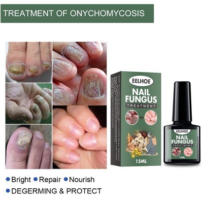 Nail Fungal Cure Nail Fungus Removal Liquid Nutritious Anti