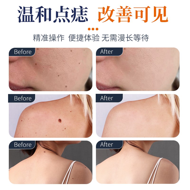 欧菲丽美点痣笔美容院专用电离子小白点痣仪家用去除斑点疙瘩仪器