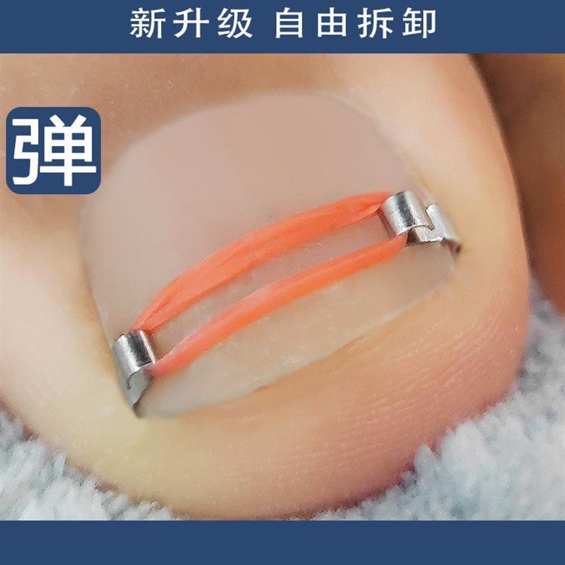 大脚趾指甲矫正器正甲扣甲
