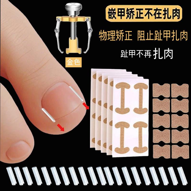 大脚趾指甲矫正器甲沟正甲