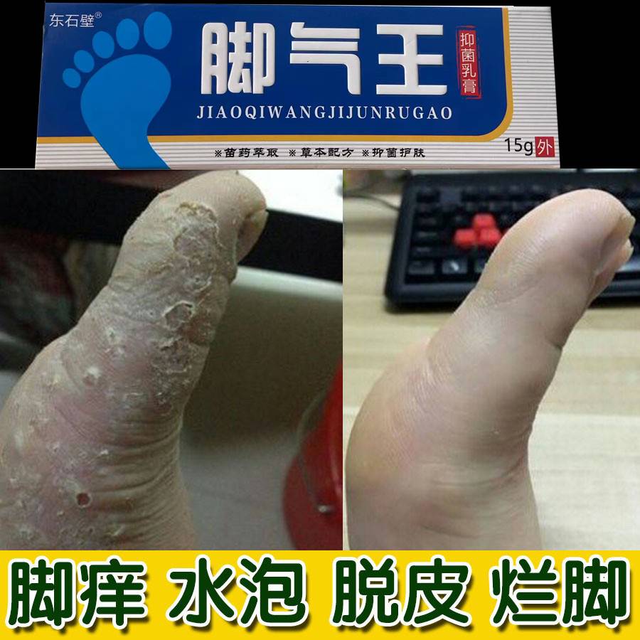 推荐香港脚气止痒脱皮杀菌脚气祛根神器治脚痒脱皮w烂脚丫水泡脚