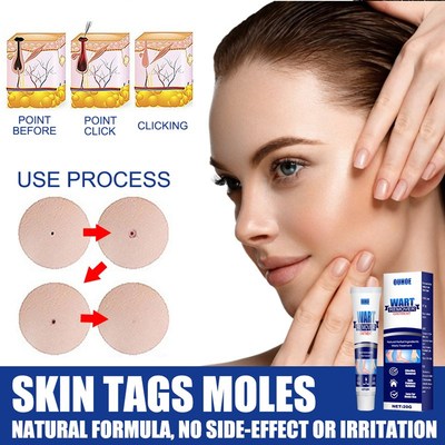 Warts Remover 去尤膏清洁皮肤修复护理身体脸部克尤膏