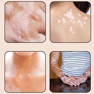 久木堂汗斑喷剂50ML/瓶 纯植物萃取 温润舒适方可携式带随用随喷