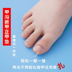 速发甲沟矫器指甲神正器嵌甲炎专用隔离填充垫片脚长甲往肉里趾纠