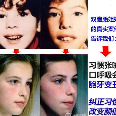 极速口呼吸矫正器训练突嘴增强唇肌闭合力量功能矫治夜防张嘴上唇