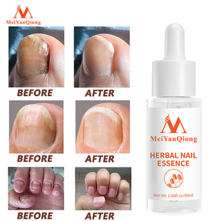 Serum Nai 极速Nail Essence and Foot Hand Treatment Care