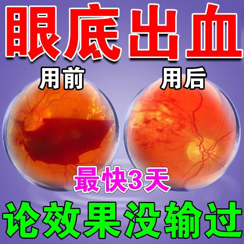 眼底出血眼水结膜炎眼膜去除红血丝抗疲劳眼底混浊发红成人专用