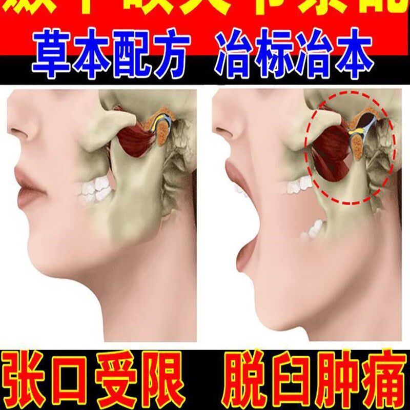 颞下颌关节紊乱热敷下巴歪大小脸偏弹响牙齿矫正器理疗张口受限症