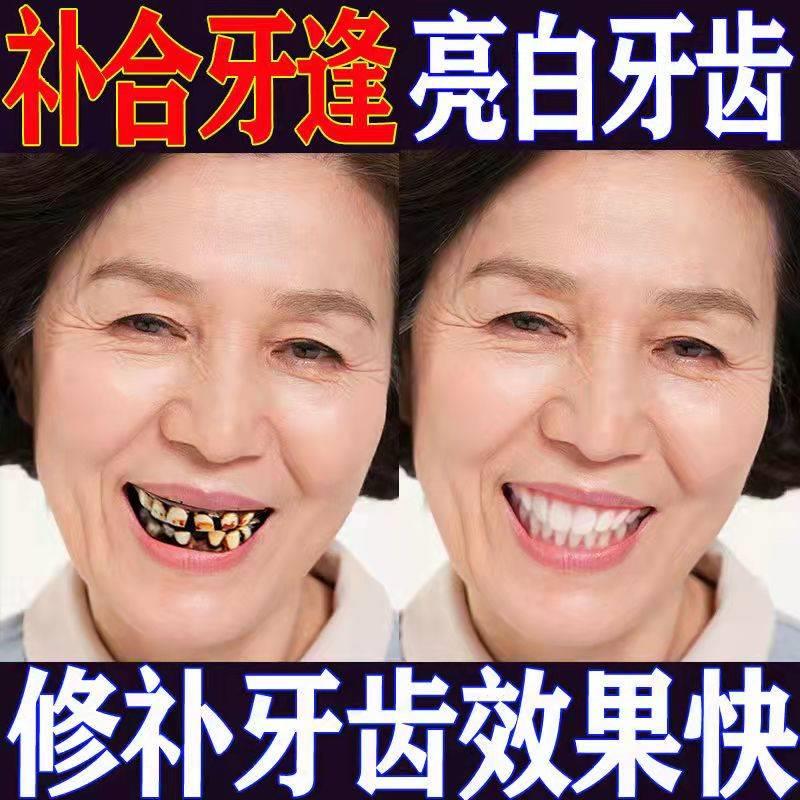 好货修补牙缝牙套子修饰牙缝牙齿补充牙不齐贴补漏稀牙怎么办神器