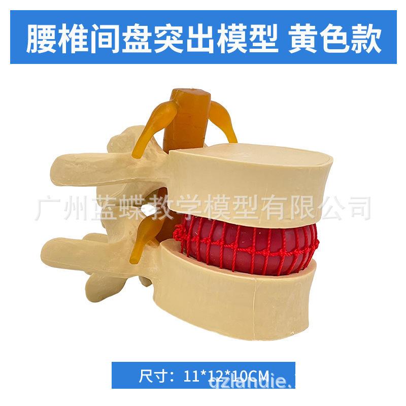 人体腰椎间盘受压演示模型腰椎放大模型病态脊柱脊椎骨骼关节爆款