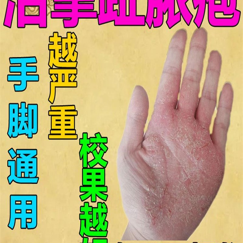 治掌趾脓疱病症手脚脓包角化病蜕皮干裂掌跖角皮症专用膏药