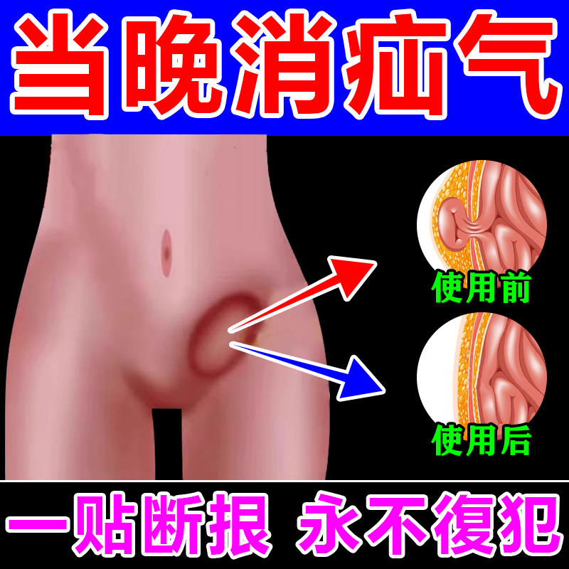 速发【J00%解决疝气】疝气专用贴腹股沟疝气斜脐疝气小肠肚疝气1L