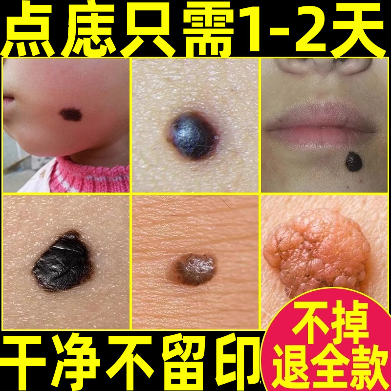 点痣膏祛痣无痕正品旗舰店去不留疤痦子除修复膏专用膏取痣神器
