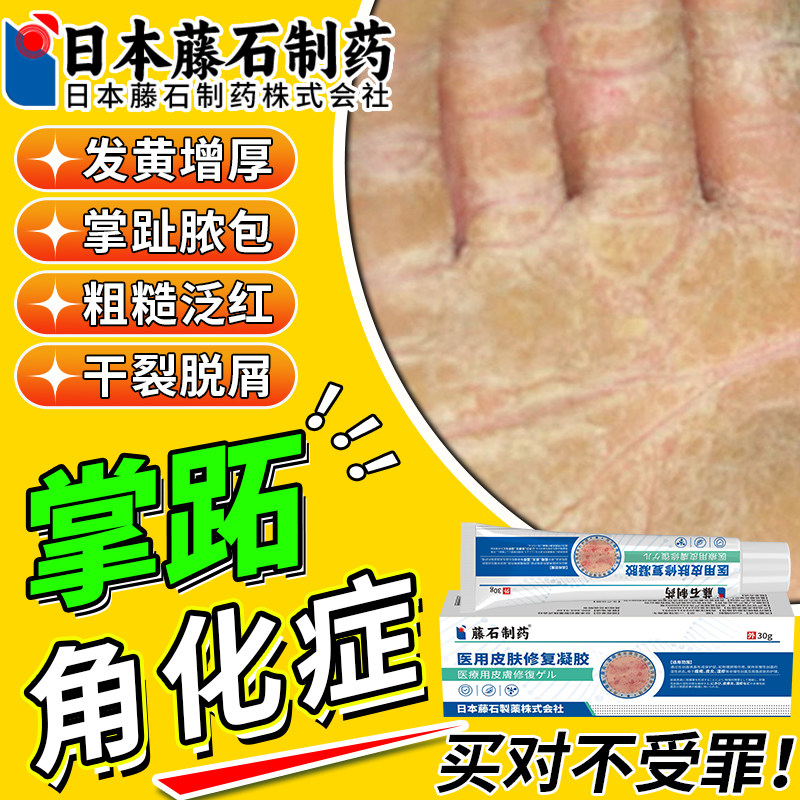 掌跖角化症掌趾脓包膏手掌心发黄增厚硬皮角化型脱皮药监备案OM