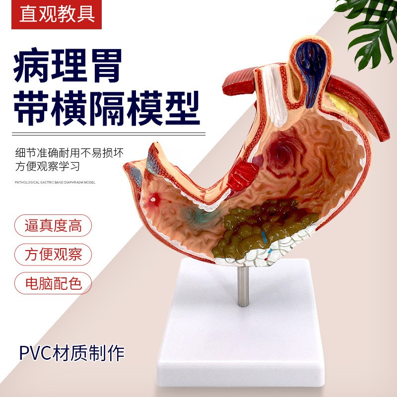 速发教学病态病胃型病理胃解剖模型解剖标本人体解剖模变模型