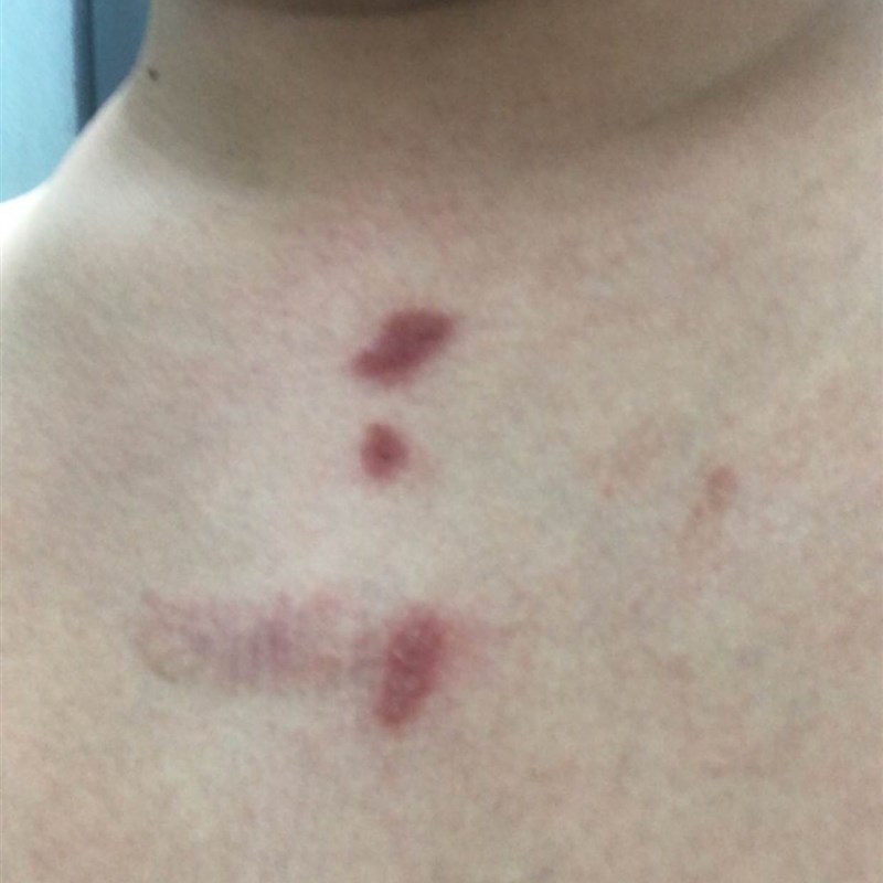 速发膏药膏感染云南本草冰浪神医华佗草止药癣本痒冰浪