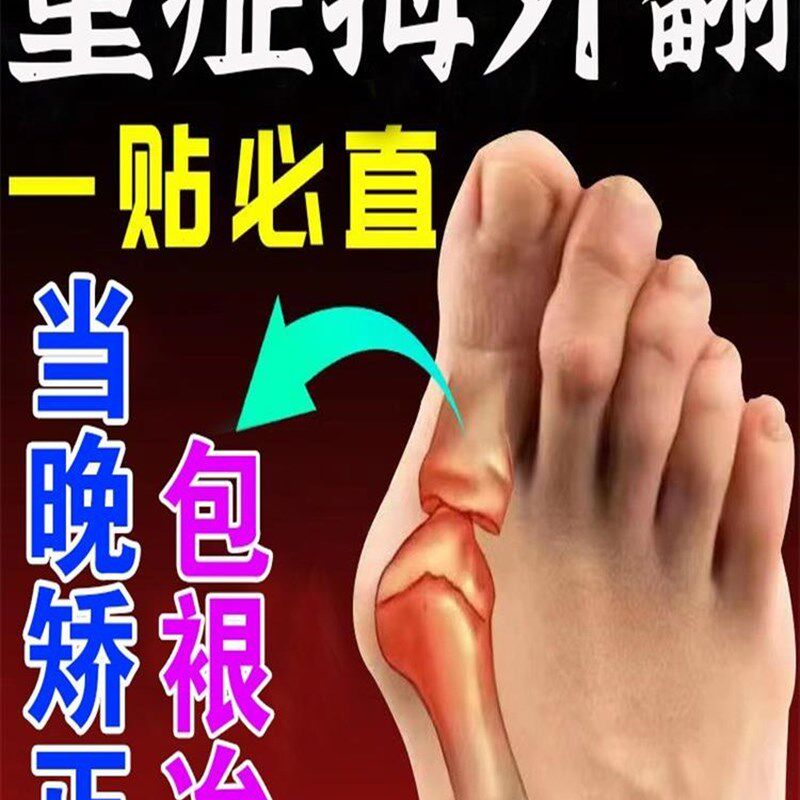速发拇外翻矫正贴节一贴矫正疼大脚骨脚趾关【拇指】痛脚趾重叠神